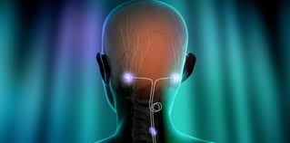 Нейростимуляция для профилактики приступов мигрени