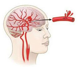 Как предупредить кровоизлияние в мозг