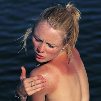 Солнечные ожоги, полученные в юном возрасте, увеличивают риск развития меланомы на 80% 