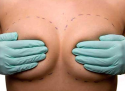 увеличение груди с помощью имплантатов