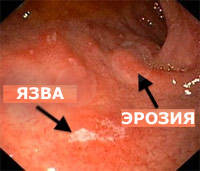 эрозия желудка, язва желудка, симптомы и признаки
