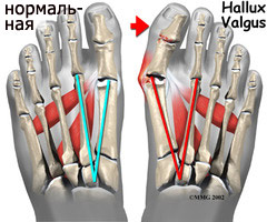 Hallux valgus, деформация стопы