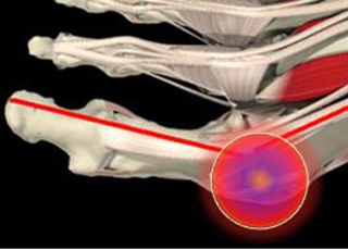 Как избавиться от Hallux valgus?