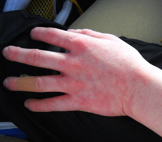 cold-20urticaria1-jpg.jpg