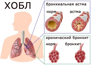 ХОБЛ, выявление проходимости бронхов