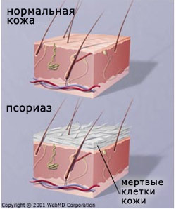 псориаз