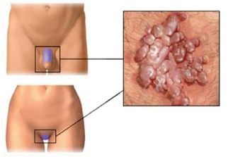 типы вируса папилломы человека, поражающие кожу и слизистые половых органов