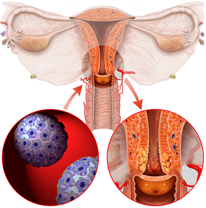 рак шейки матки, причины