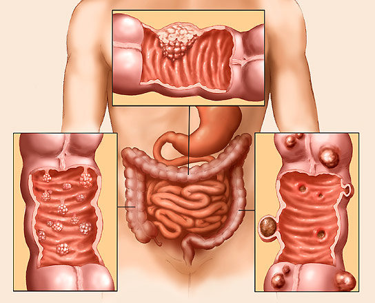 Рак толстой кишки 
