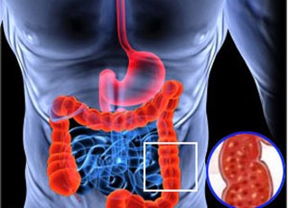 Хронический колит. О причинах заболевания, диагностике и лечении
