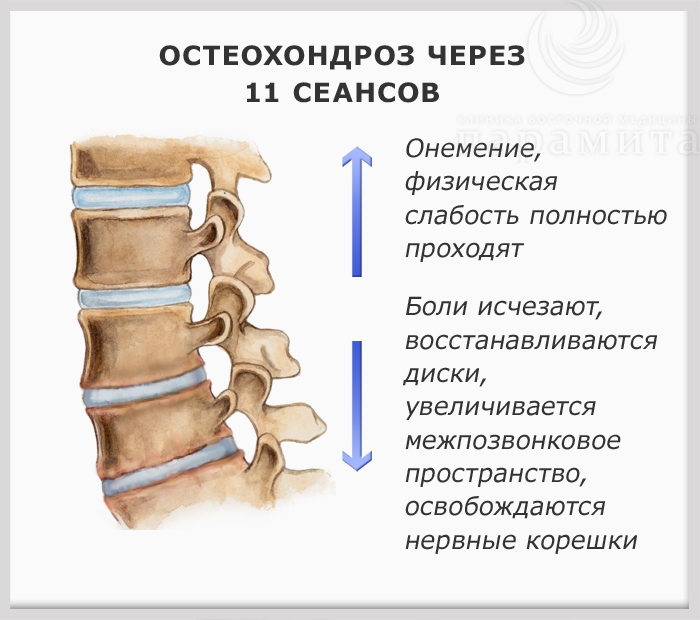 Остеохондроз, лечение, через 11 сеансов