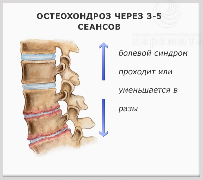 Остеохондроз, во время лечения, через 3-5 недель