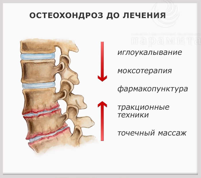 Остеохондроз, до лечения