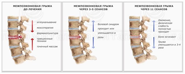 Лечение межпозвонковой грыжи 