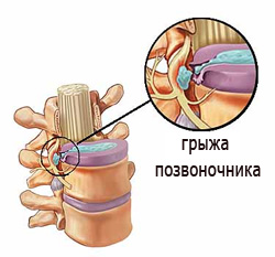 грыжа позвоночника