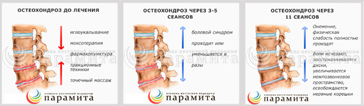 восточные методы лечения остеохондроза