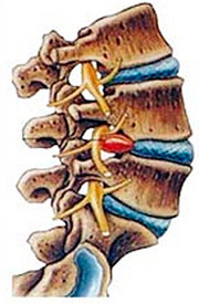 причины возникновения межпозвонковой грыжи