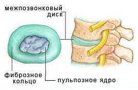 Строение межпозвонковых дисков 