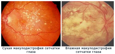 дистрофия сетчатки глаза