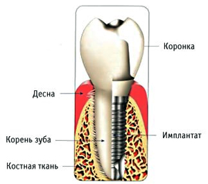 имплантат бренемарка 