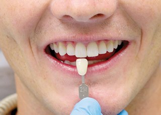 Отбеливание зубов — не только для звезд