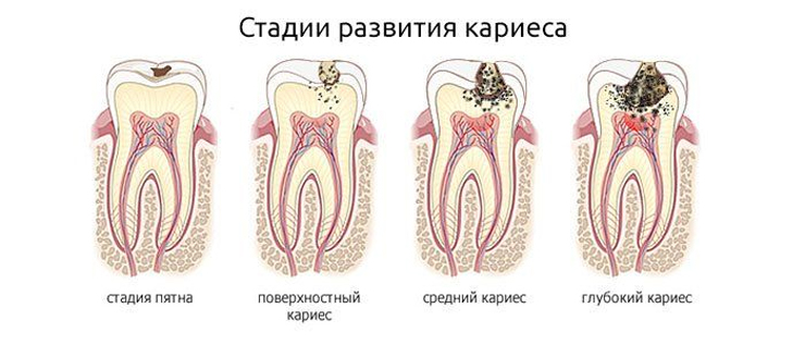 стадии развития кариеса