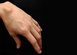 Что за странная шишка на кисти? Гигрома, или синовиальная киста. Что за странная шишка на кисти? Гигрома, или синовиальная киста.